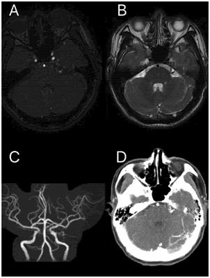 Trigeminal neuralgia associated with dural arteriovenous fistula: a case report and literature reviews